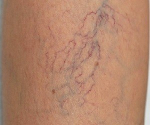 extension-varicose veins