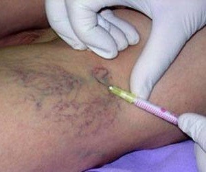 sting-of-varicose veins