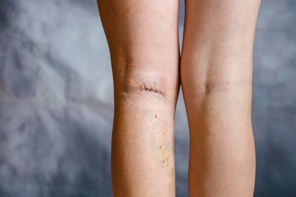 seam on the leg after surgery for varicose veins