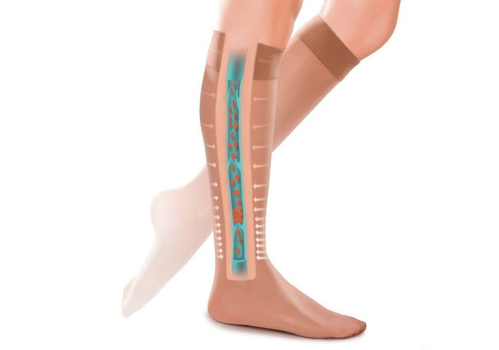 the effect of compression stockings on the legs with varicose veins