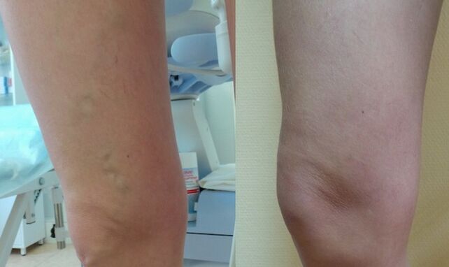 leg before and after the treatment of reticular varicose veins