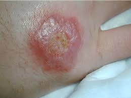 ulcers of the skin,