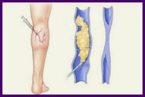 Sclerotherapy is a popular method of eliminating varicose veins on the legs