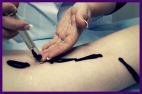 The procedure for the treatment of varicose veins with leeches (hirudotherapy)
