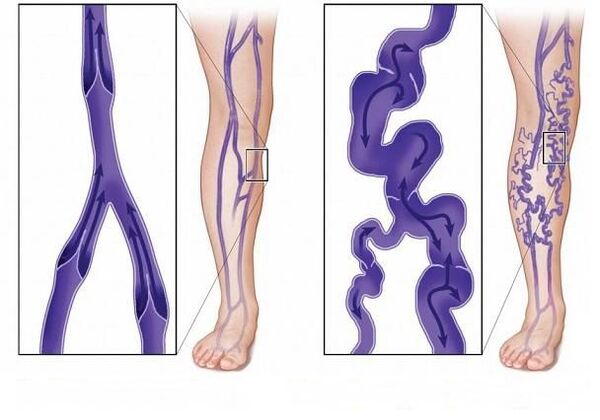 normal venous valves and valves with varicose veins