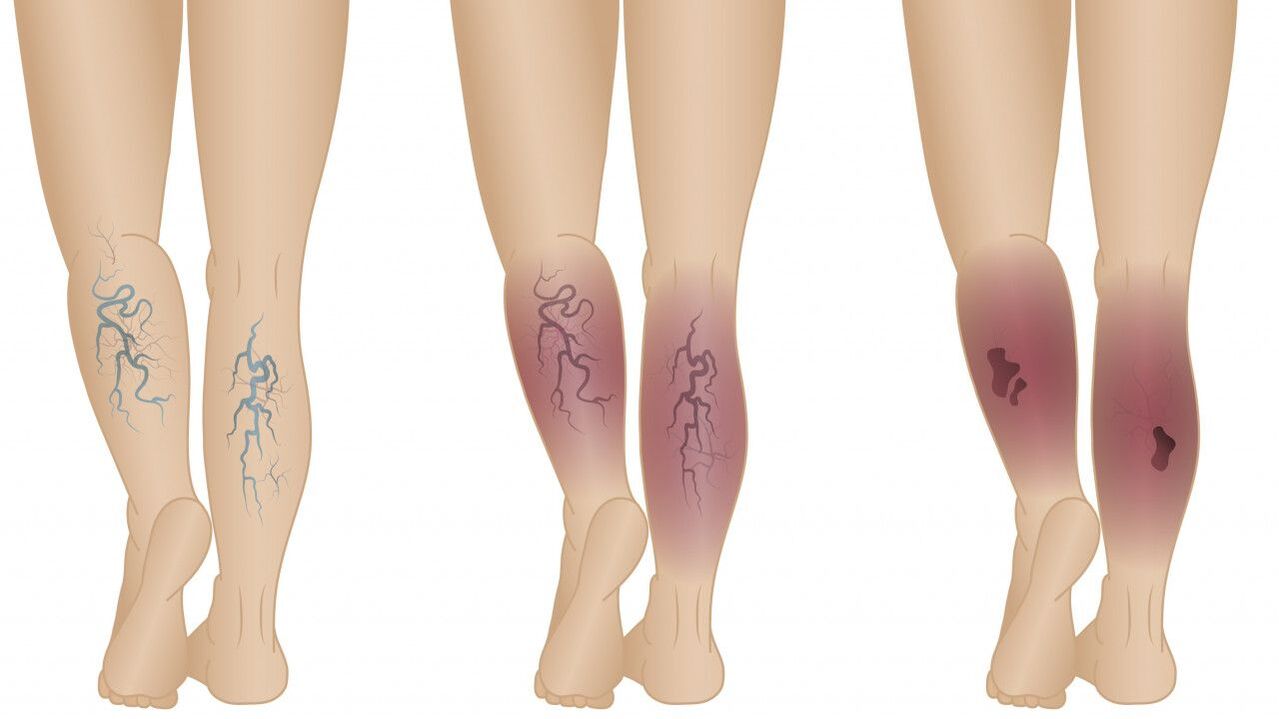 stages of development of varicose veins