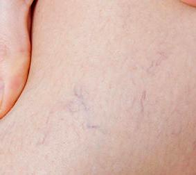 the phase of varicose veins