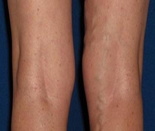 the treatment of varicose veins on the legs