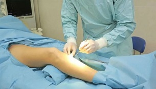 how the operation is performed for varicose veins