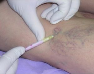 the pain during the varicose veins fluid treatment