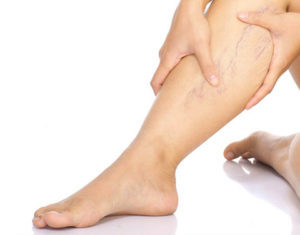the pain during the varicose veins