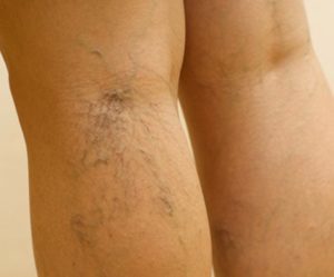 the pain in the varicose veins treatment