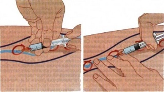methods of treatment of varicose veins