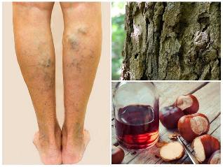 treatment of varicose veins on legs folk remedies