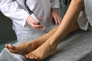 the treatment of varicose veins