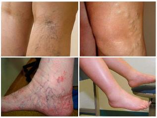 the phase of varicose veins