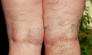 the spider veins on the legs