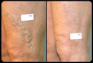 Before and after vein surgery