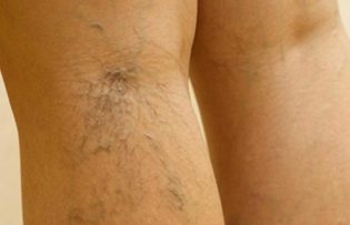 the treatment of varicose veins on the legs