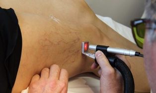 treatment of varicose veins by laser