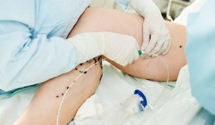 methods of treatment of varicose veins on the legs in women