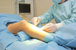 A varicose veins surgery