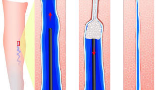 Introduction sclerosant during sclerotherapy