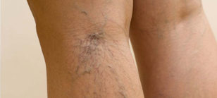 The spider veins on the legs